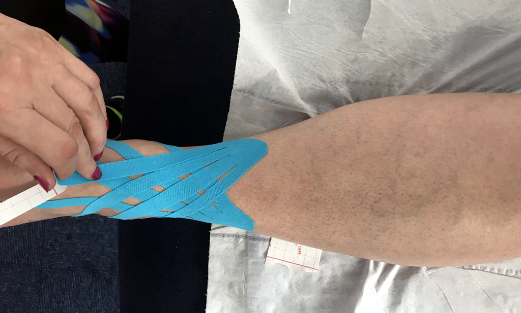 kinesiology taping completed on a patients leg